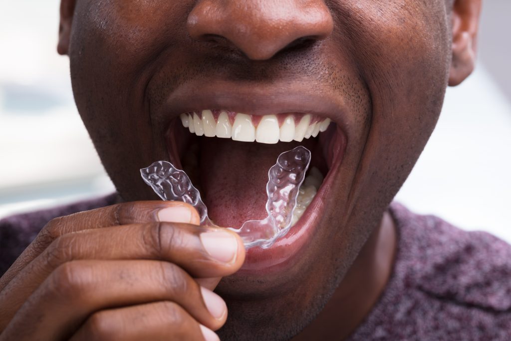 invisible aligners or braces invisible aligners or braces